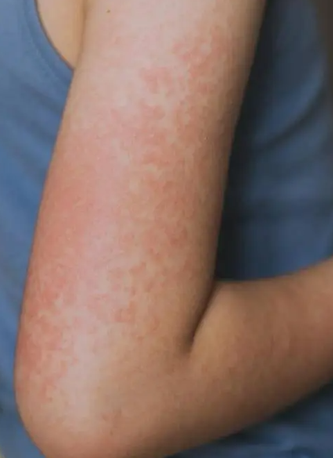 冬季热射病频发需引起高度警惕：过长泡温泉与运动时穿着厚重是主要诱因